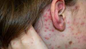 ANTE ALERTA POR SARAMPIÓN, DETALLAN SÍNTOMAS CLAVE PARA EVITAR MÁS CONTAGIOS